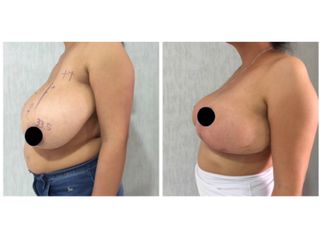 Antes y después de Mastopexia