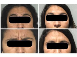Antes y después de Aplicación de toxina botulínica