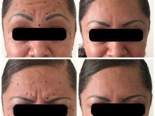 Antes y después de Aplicación de toxina botulínica