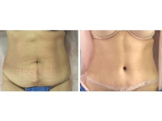 Antes y después de Abdominoplastia