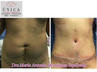 Antes y después de Abdominoplastia