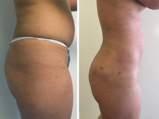 Antes y después de Lipoescultura