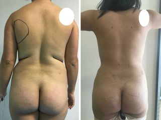 Antes y después de Lipoescultura