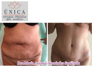 Antes y después de Abdominoplastia