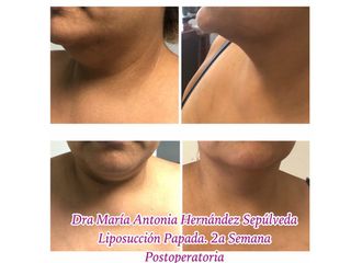 Antes y después de Liposucción
