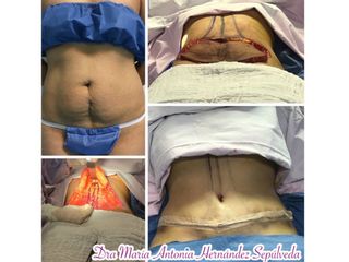 Antes y después de Abdominoplastia