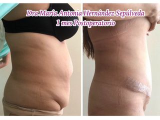 Antes y después de Abdominoplastia