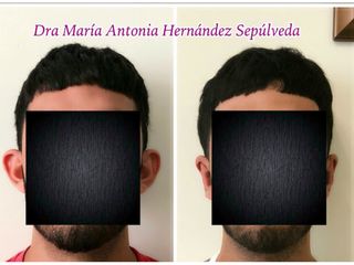 Antes y después de Otoplastia