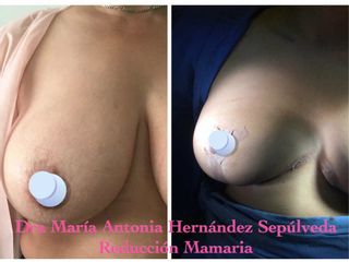 Antes y después de Reducción de mamas 