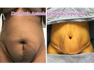 Antes y después de Abdominoplastia
