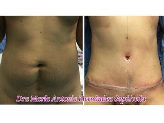 Antes y después de Abdominoplastia