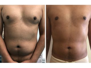 Antes y después de Mastopexia