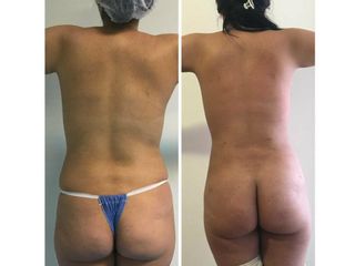 Antes y después de Lipoescultura