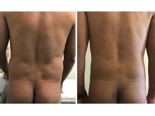 Antes y después de Lipoescultura