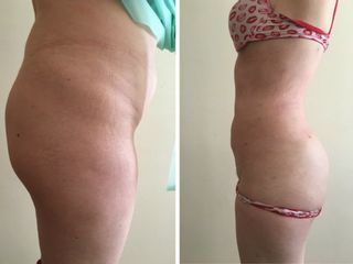 Antes y después de Lipoescultura