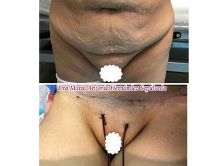Antes y después de Abdominoplastia
