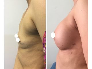 Antes y después de Aumento de busto
