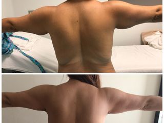 Antes y después de Braquioplastia