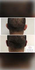 Antes y después de tratamiento para alopecia