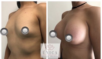 Antes y después de Aumento de busto
