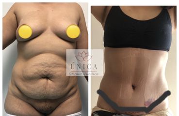Antes y después de Abdominoplastia