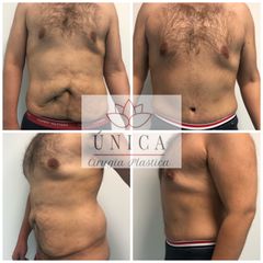 Antes y después de Abdominoplastia