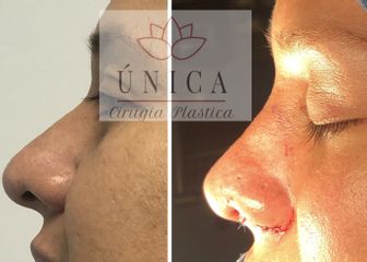 Antes y después de Rinoplastia