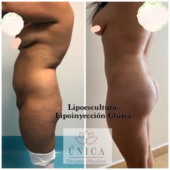 Antes y después de Liposucción