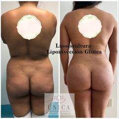 Antes y después de Liposucción