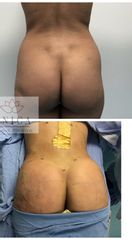 Antes y después de Gluteoplastia