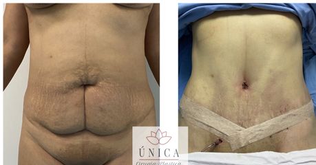 Antes y después de Abdominoplastia