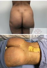Antes y después de Gluteoplastia