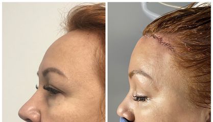 Antes y después de Cirugía facial 