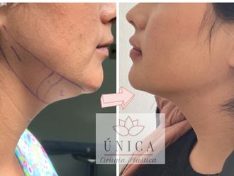 Cirugía de papada antes y después - 808663