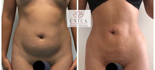 Antes y después de Liposucción