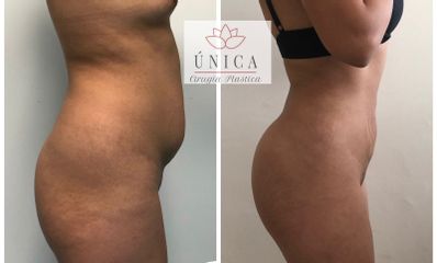 Antes y después de Liposucción