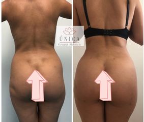 Antes y después de Liposucción