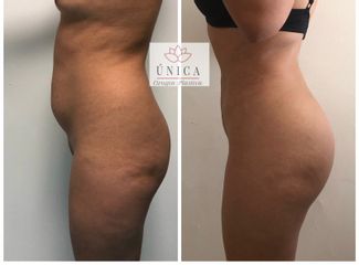 Antes y después de Liposucción