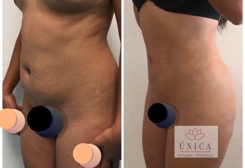 Antes y después de Liposucción