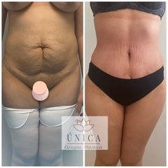 Antes y después de Abdominoplastia 