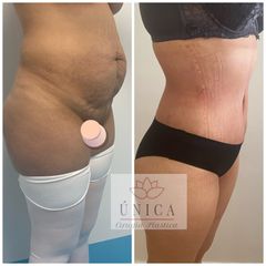 Antes y después de Abdominoplastia