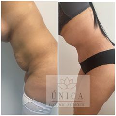 Antes y después de Abdominoplastia