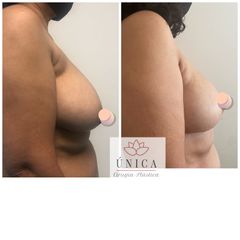 Antes y después de Mastopexia