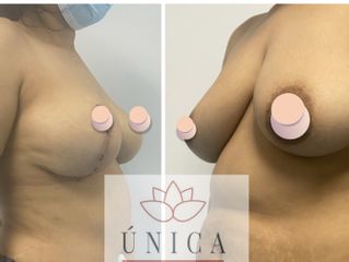 Antes y después de Mastopexia