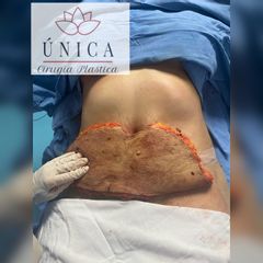 Abdominoplastia