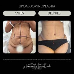 Lipoabdominoplastia - Dra. Maria Antonia Hernández Sepúlveda