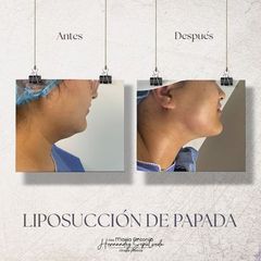 Liposucción de papada - Dra. Maria Antonia Hernández Sepúlveda