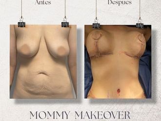 Mommy makeover antes y después - 870732