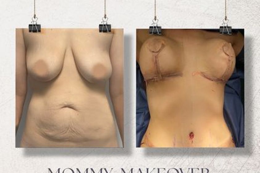 Mommy makeover antes y después - 870732