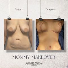 Mommy makeover - Dra. Maria Antonia Hernández Sepúlveda